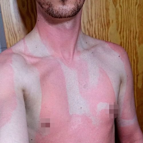 Urticaria solar - Bampirillo