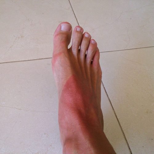 Urticaria solar - Bampirillo