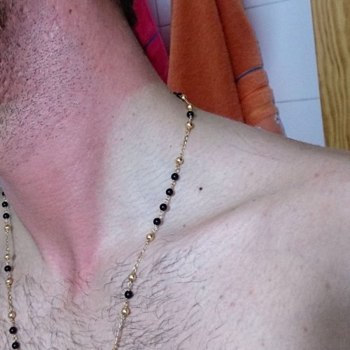 Urticaria solar - Bampirillo