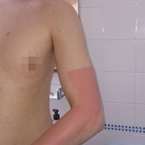 Urticaria solar - Bampirillo
