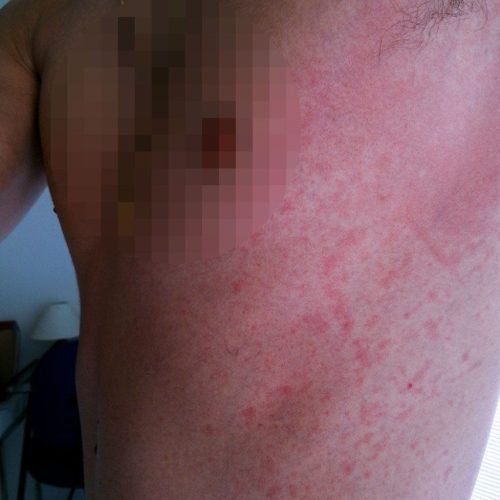 Urticaria solar - Bampirillo